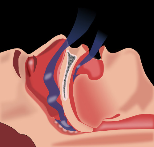 Храп – один из основных симптомов ночного апноэ – периодической закупорки верхних дыхательных путей во время  сна