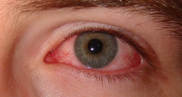Хроническое раздражение глаз при СИПАП-терапии