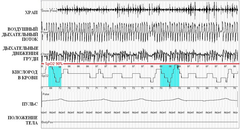 Кардиореспираторное мониторирование во время сна у больного с синдромом ожирения-гиповентиляции (фрагмент записи №2)