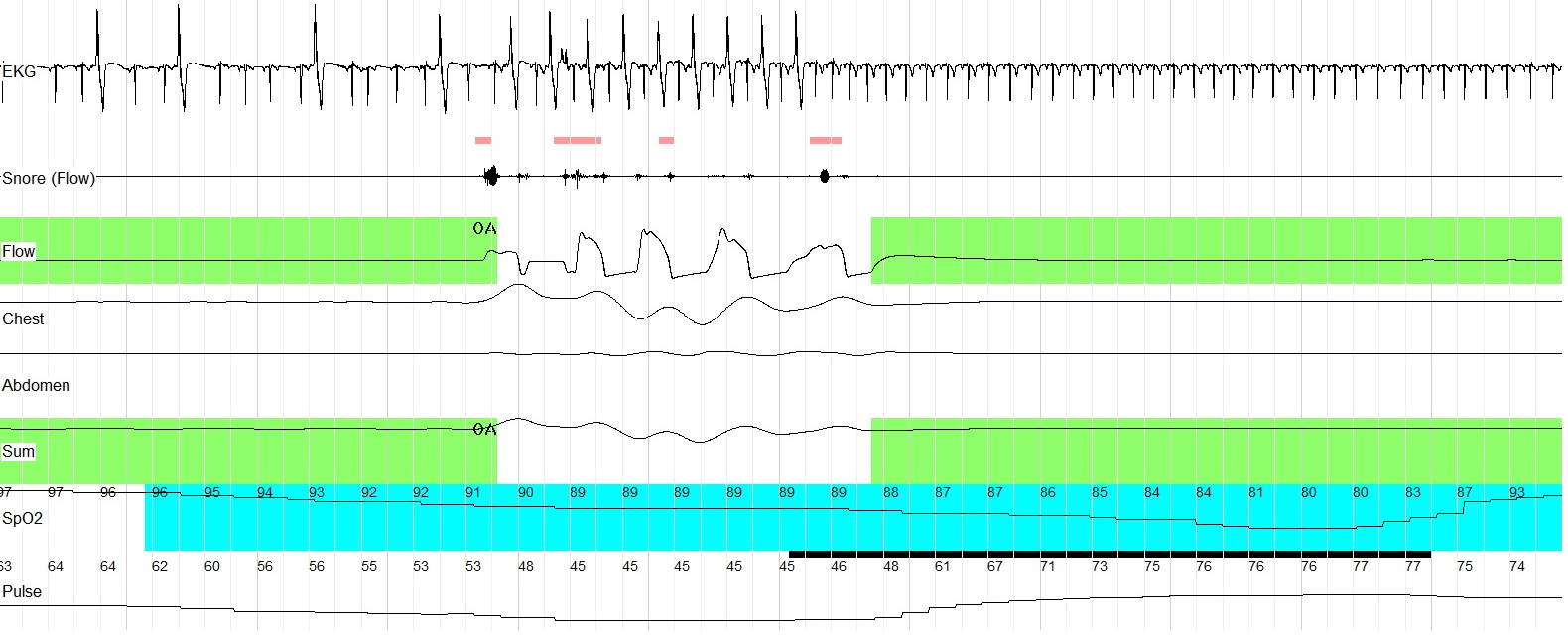 Кардиреспираторное мониторирование (фрагмент записи 60 сек.). На фоне восстановления дыхания после обструктивного апноэ, длившегося 63 сек., регистрируется частая ЖЭ (бигеминия)