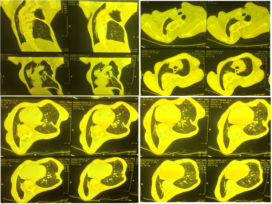Компьютерная томография органов грудной клетки пациентки Ш., декабрь 2014 г. (описание в тексте).
