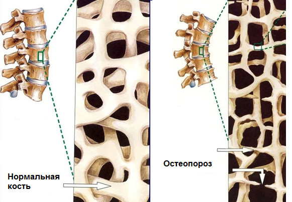 Нормальные костные структуры широкие и прочные