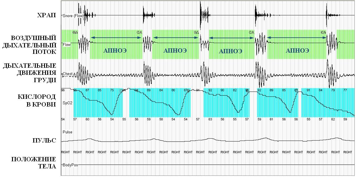 Кардиореспираторное мониторирование во время сна у больного с синдромом ожирения-гиповентиляции (фрагмент записи №1)