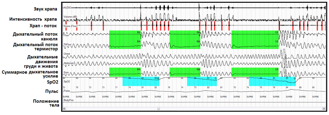 Пример ночной записи пациента с СОАС с использованием кардиореспираторного монитора MediByte МР-8