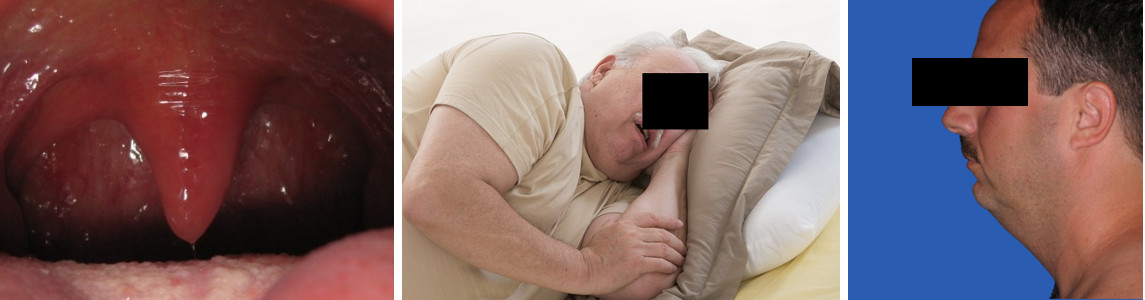 Аномалии глотки, избыточный вес и маленькая нижняя челюсть – основные причины храпа и апноэ сна