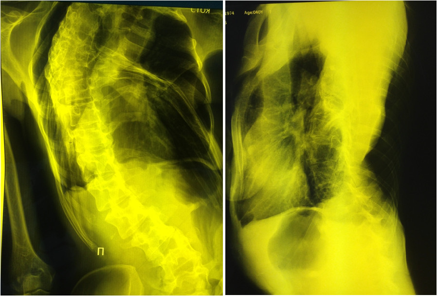 Рентгенография органов грудной клетки пациентки Ш., декабрь 2014 г. (комментарии в тексте).