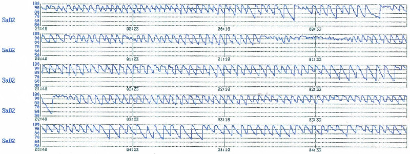 Пульсоксиметрическое мониторирование во время сна у пациента с тяжелым СОАС. Видны циклически повторяющиеся эпизоды десатурации.