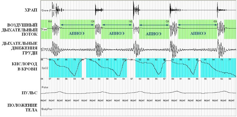 Результаты кардиореспираторного мониторировния при тяжелом апноэ сна (фрагмент записи)